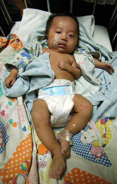 Three-armed baby receives treatment in Shanghai