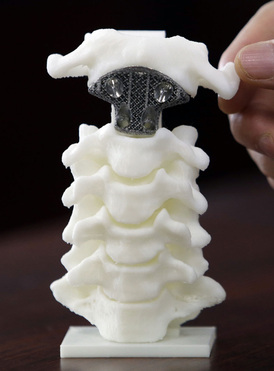 First 3D-printed artificial axis in China